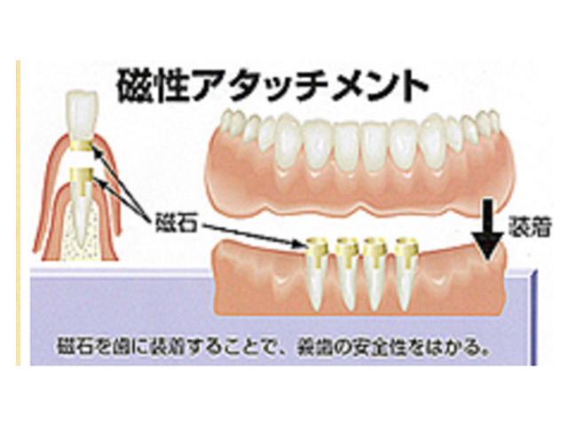 「磁石＋入れ歯」の磁性アタッチメント義歯